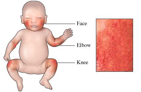 Márketing del miedo: En España hay más niños que sufren Dermatitis atópica que niños